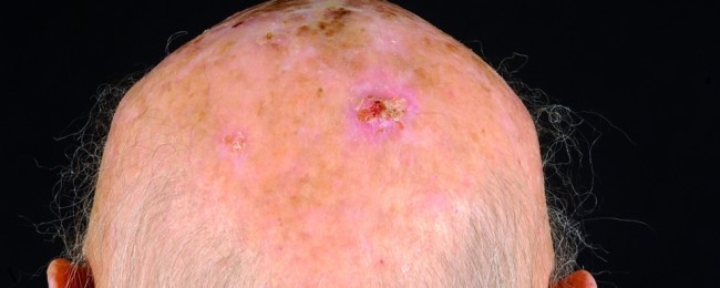 Verandering van actinische keratose naar plaveiselcelcarcinoom