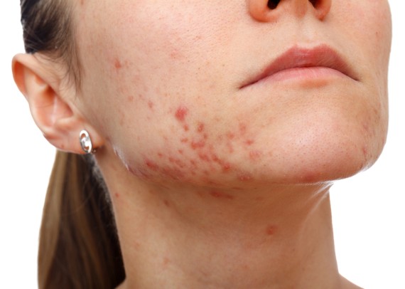 Acne